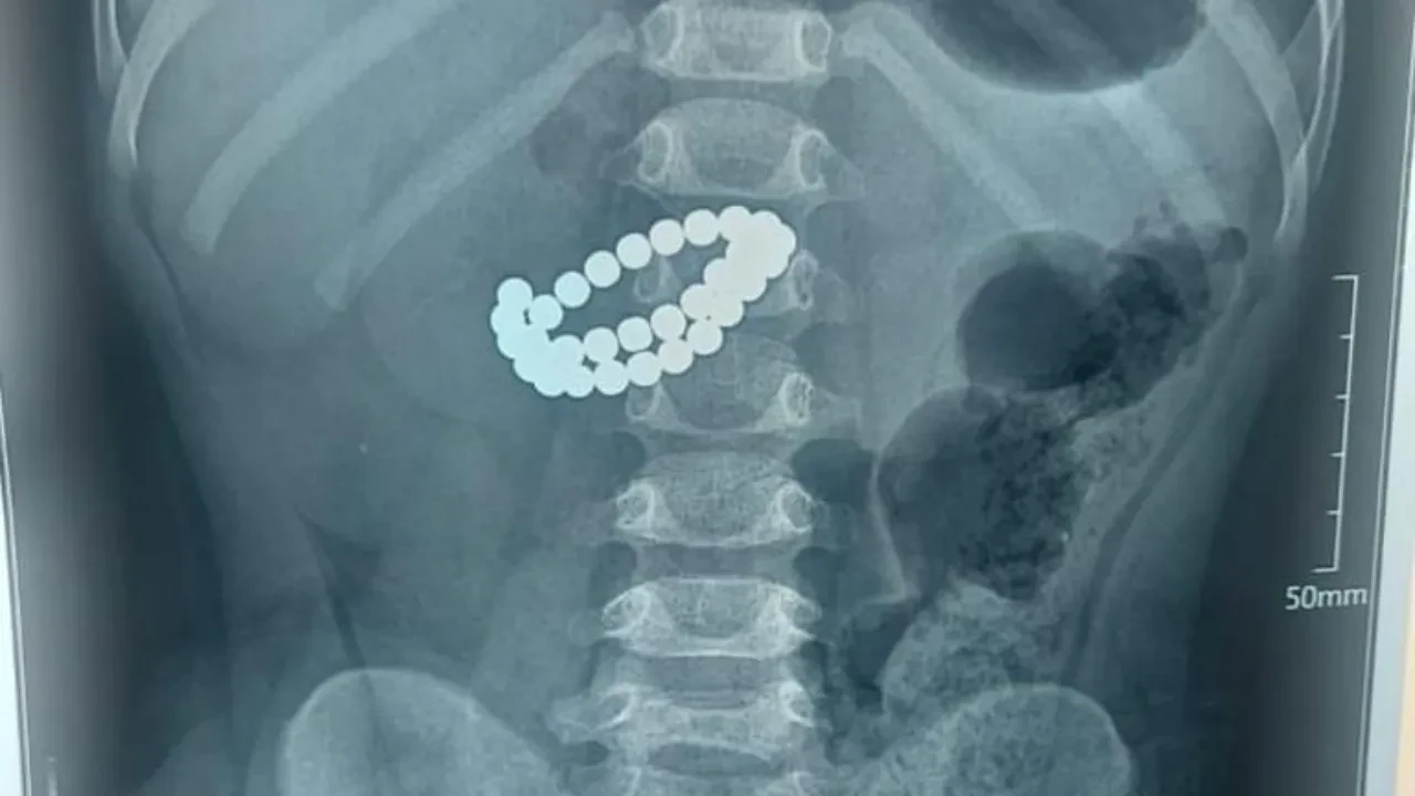 31 магнит оказался в кишечнике полуторагодовалого ребенка в Алматы