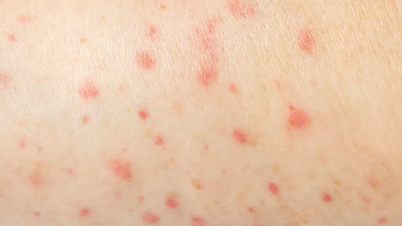 Единственный город, в котором не зарегистрировали корь в 2026