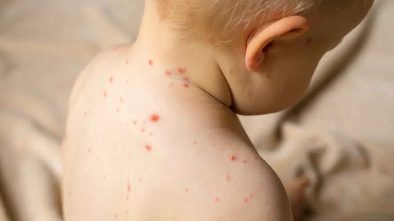 Енді Астанада қызылшаға қарсы екпе алмаған балаларды ауруханаға жатқызбайды